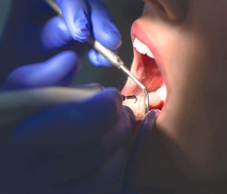 Diastema Closure