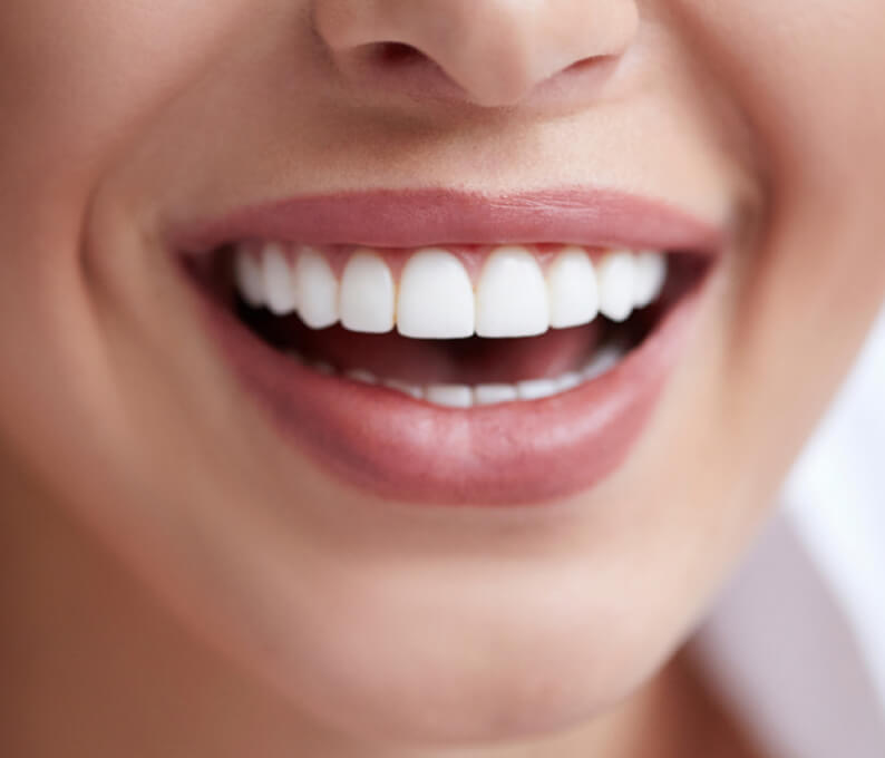 Teeth Whitening