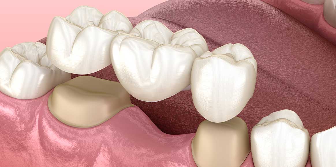 Crown And Fixed Bridge Precision Smile Dental Clinic