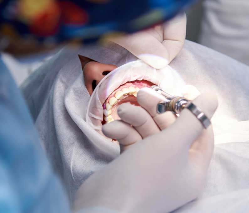 Frenectomy
