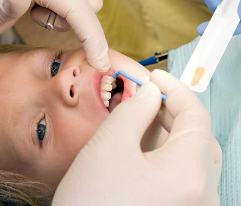 Fluoride Treatment