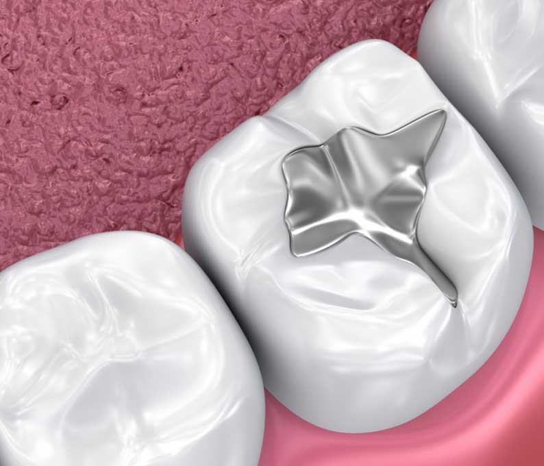 Pit and Fissure Sealants