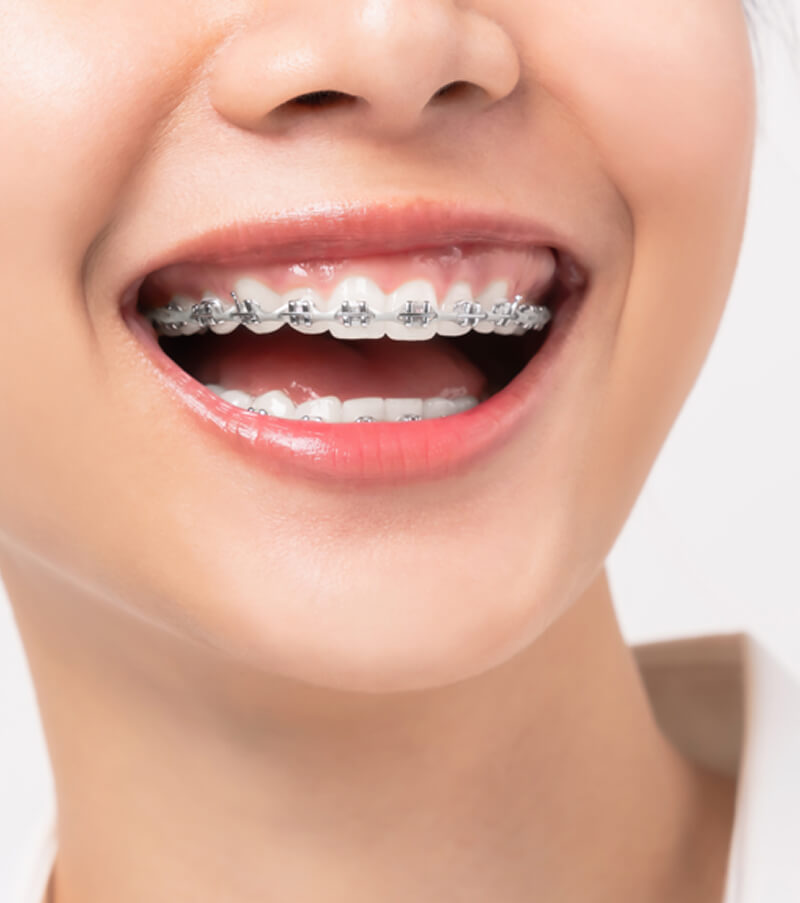 Braces