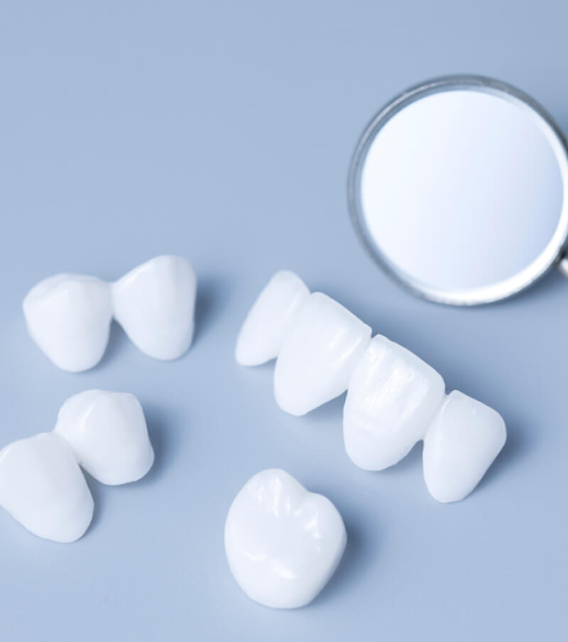 Veneers