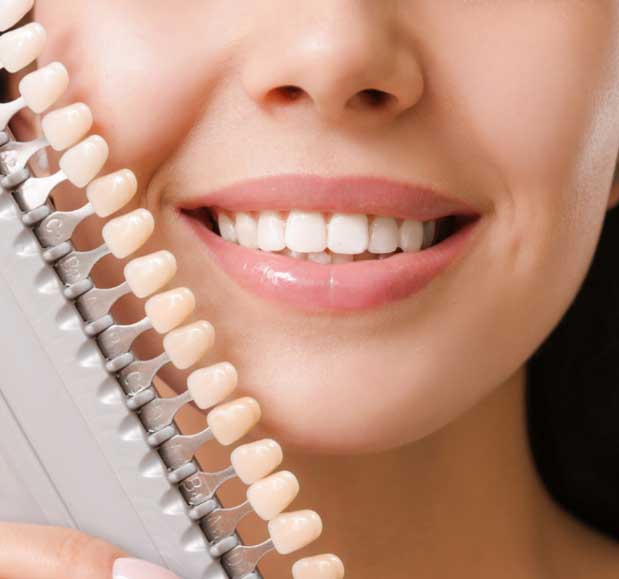 Veneers